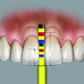 3 capete de rezerva pentru distantier estetic Chu (masurarea papilei dentare)